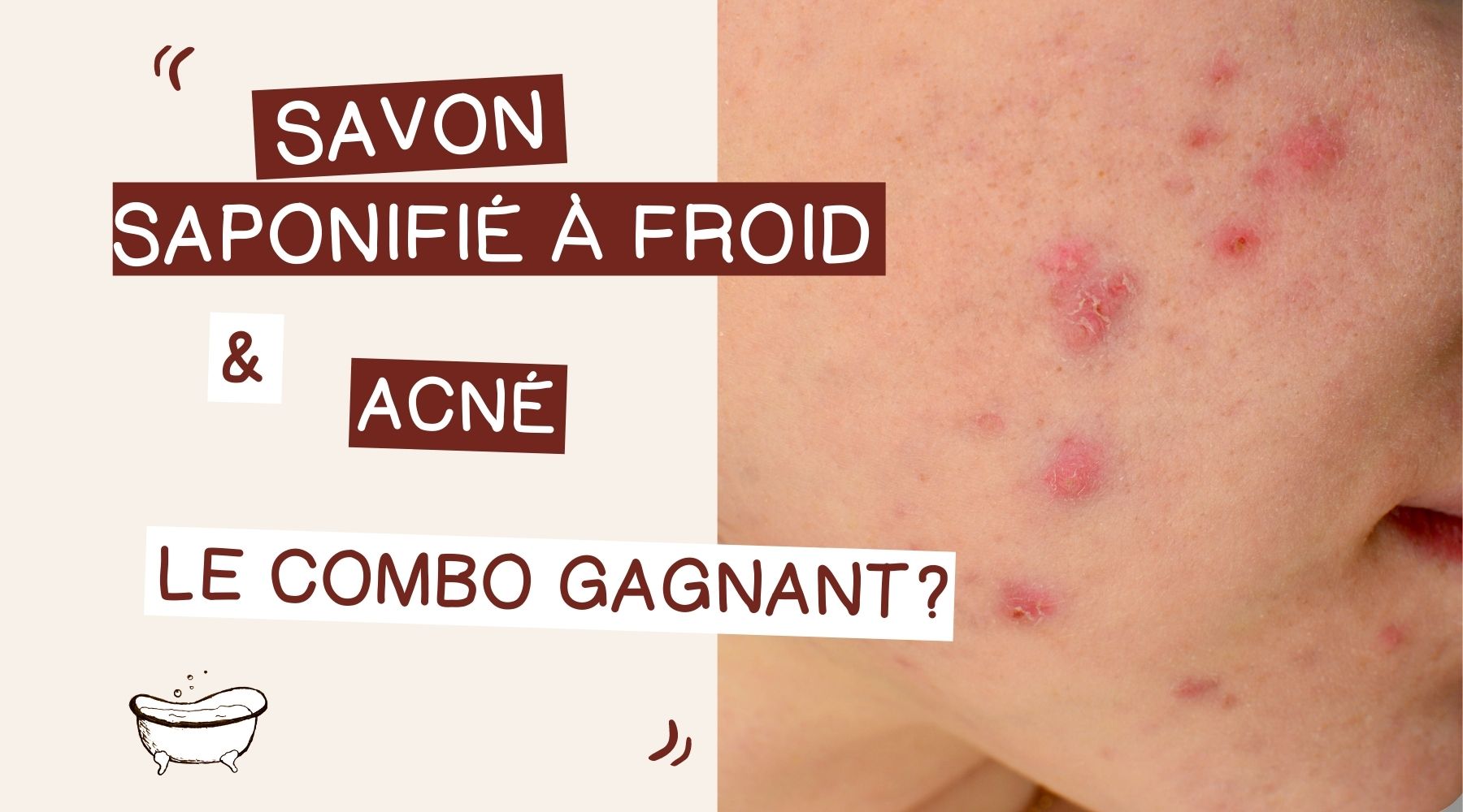 Savon saponifié à froid et acné : quelle efficacité ?