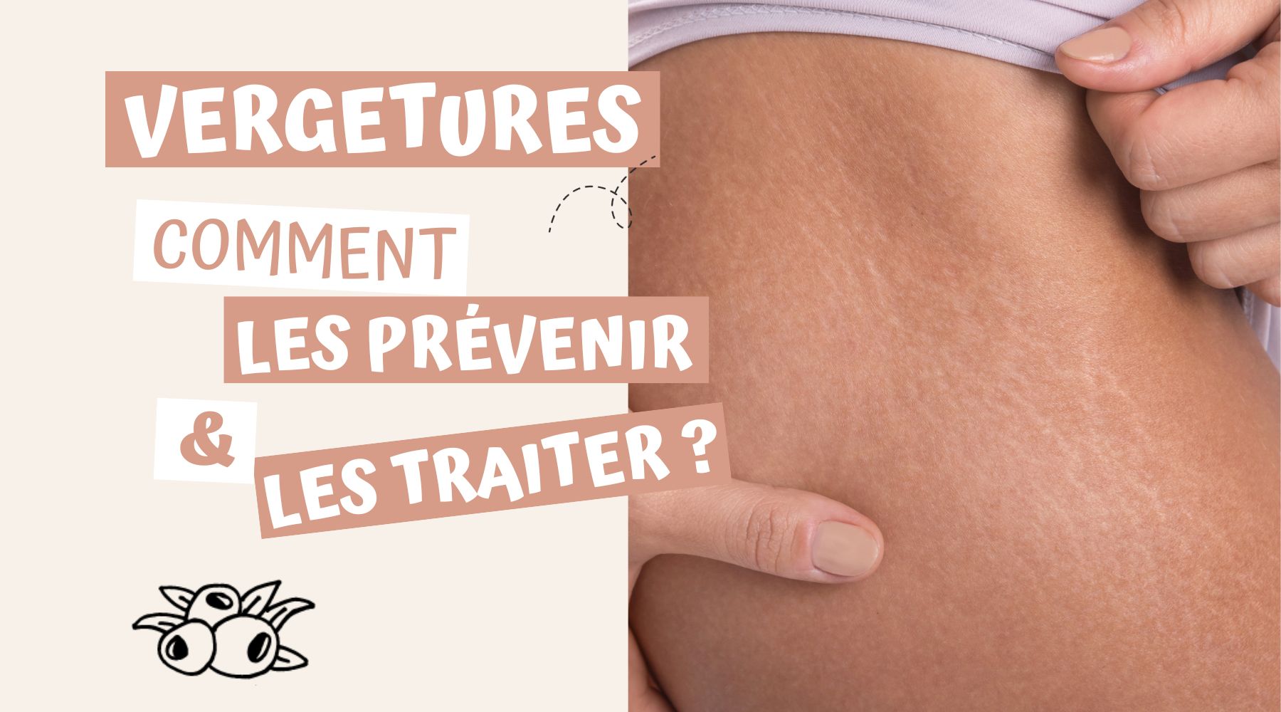 Prévenir et traiter les vergetures avec des cosmétiques naturels